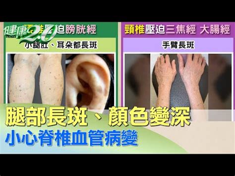 腳背長斑|【腳背長斑】腳背長斑別輕忽！常見原因、症狀與治療。